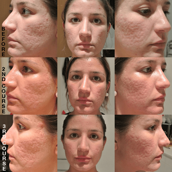 ZENMED Skin eraser before and after - somanylovelythings